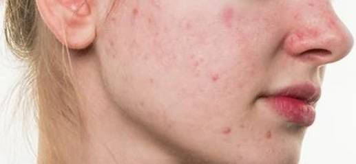 /脸上的痘印消不去 可能是你护肤有问题